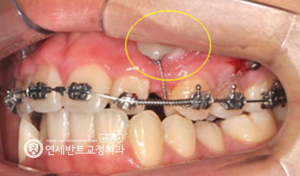 측면 장치 사진