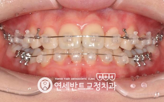교정 장치 사진