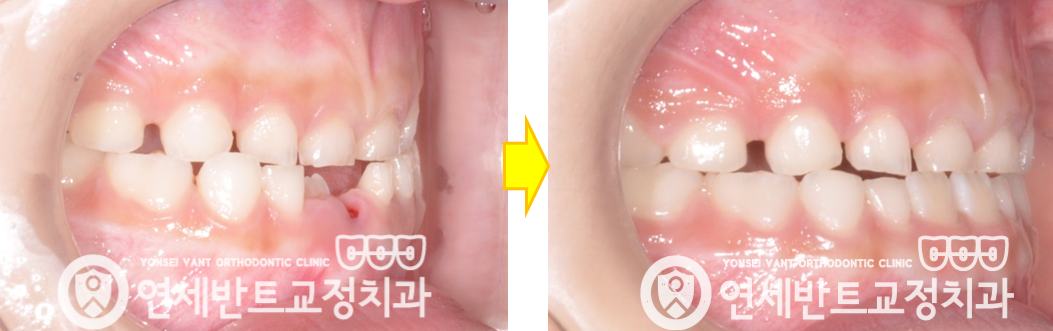 교정 전후 비교