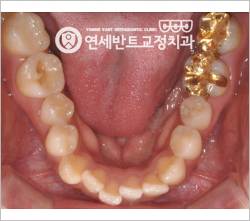 아래 치열 사진