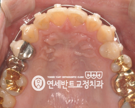 위 치열 사진