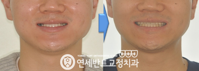 얼굴 전후 비교