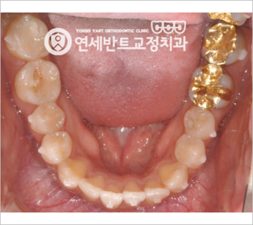 아래 치열 사진