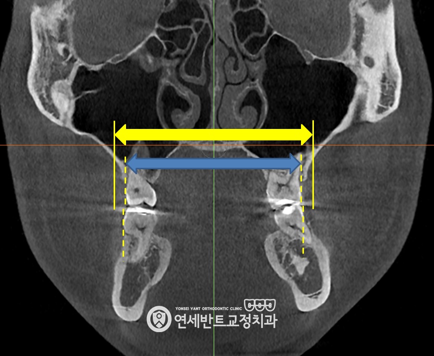 상악 CT 단면