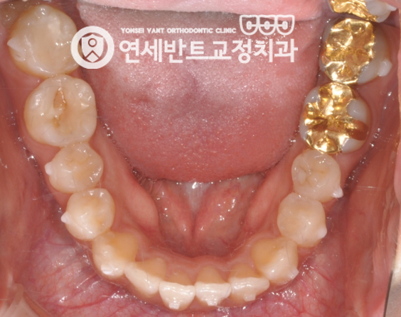 아래 치열 사진