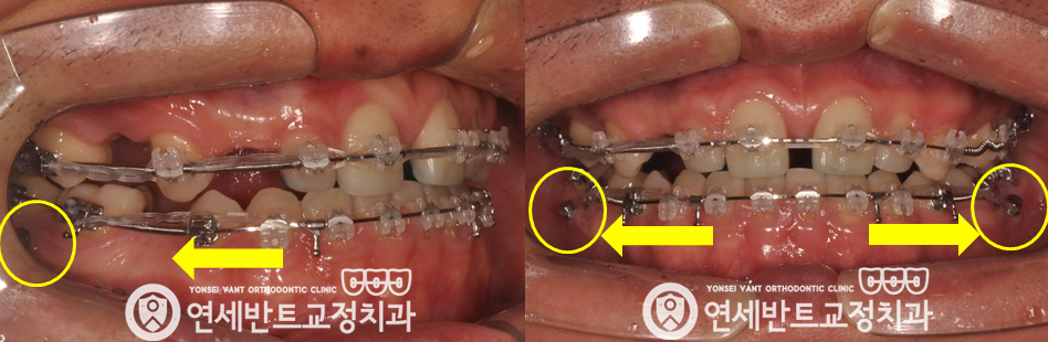 앞니 구강 사진