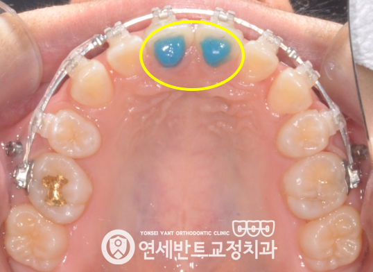 위턱 장치 사진