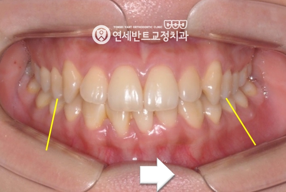 앞니 정면 사진