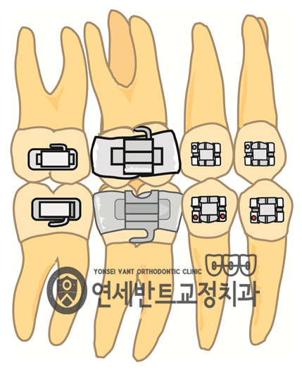 치아 배열 도해