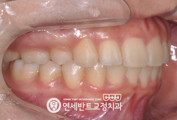 측면 교합 사진