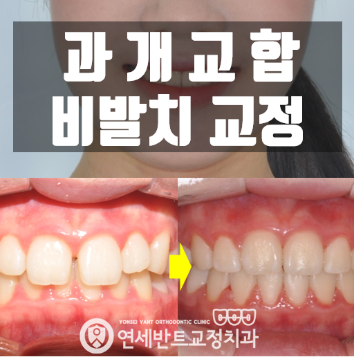 과개교합 교정