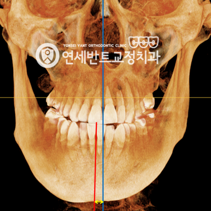 인천안면비대칭교정 비수술로 가능한 진단 기준은?