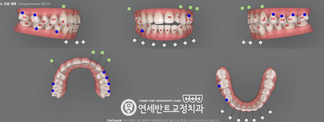 치아 3D 스캔