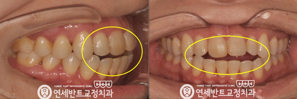 앞니 구강 사진