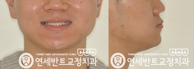 얼굴 전후 비교