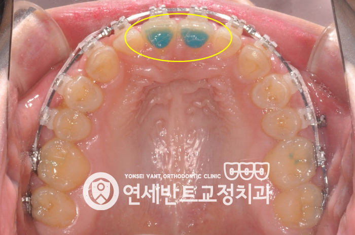 위턱 장치 사진