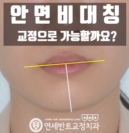 안면비대칭 교정
