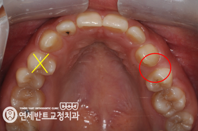 위 치열 사진