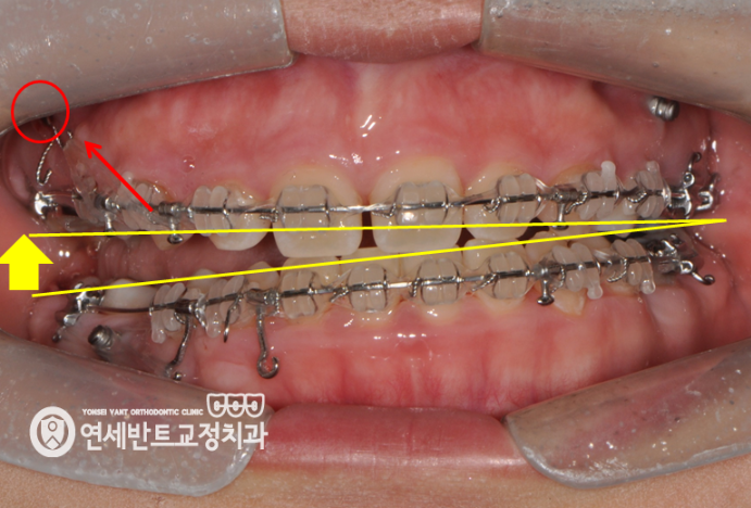 교정 장치 사진