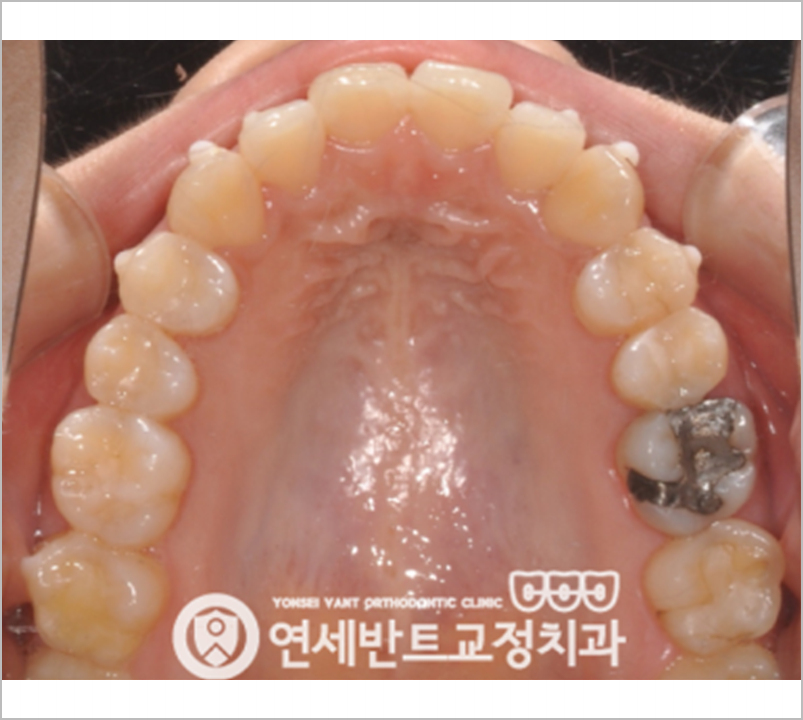 위 치열 사진