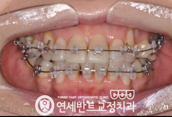 교정 장치 사진