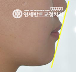 옆모습 기준선