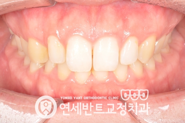 앞니 정면 사진