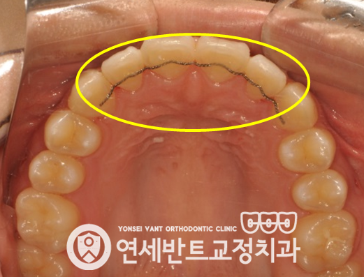 위 치열 사진