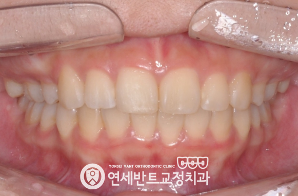 측면 교합 사진