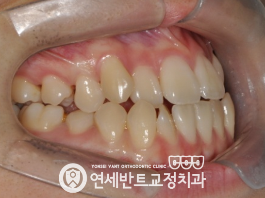 측면 교합 사진