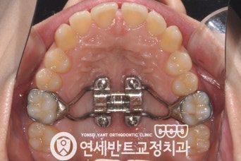 위턱 확장장치