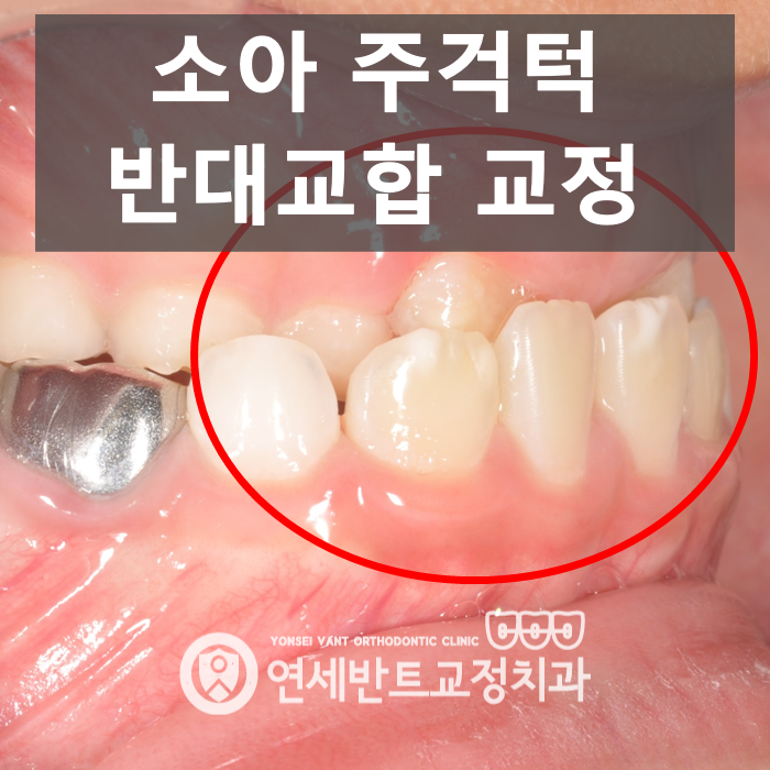 남동구에서 아이 인천 주걱턱교정, 언제 시작할까