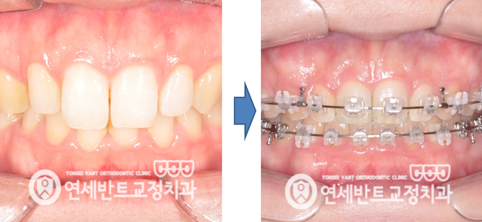 교정 전후 비교