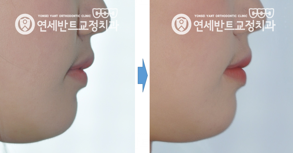 옆모습 전후 비교