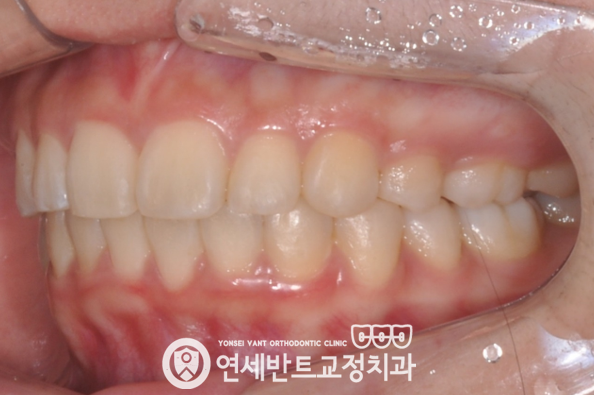 측면 교합 사진