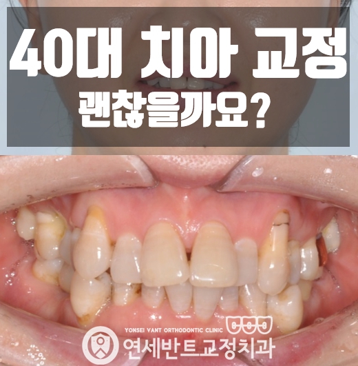 인천 송도교정치과 40대 50대 치아교정 가능할까