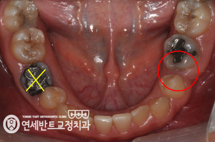 어금니 구강 사진