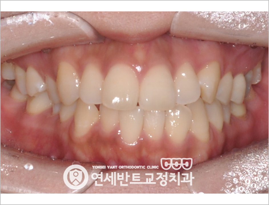 앞니 정면 사진