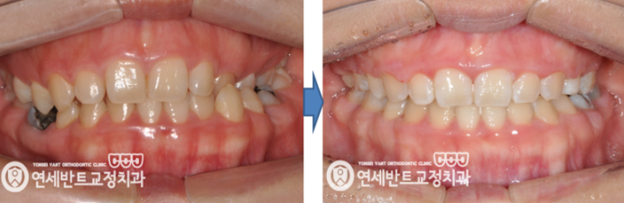 교정 전후 비교
