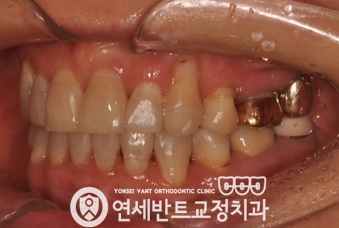 측면 교합 사진