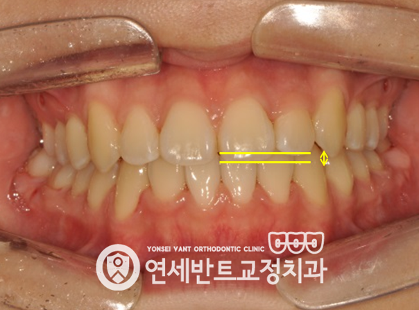 앞니 정면 사진