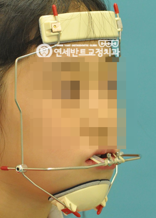 구외 장치 착용