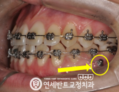 측면 장치 사진