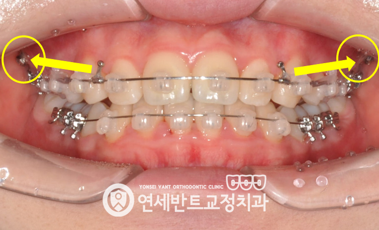 교정 장치 사진