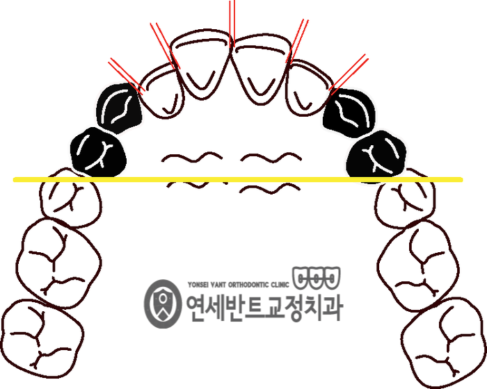 치아 배열 도해