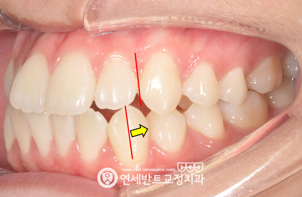 앞니 측면 확대