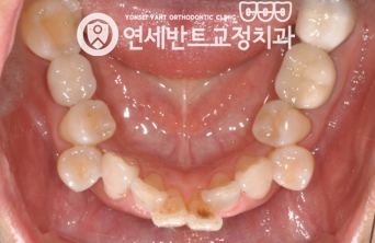 아래 치열 사진