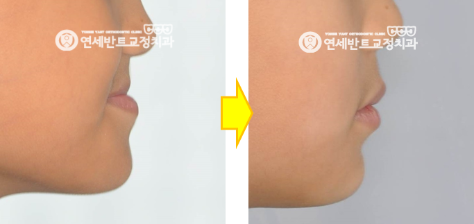 옆모습 전후 비교