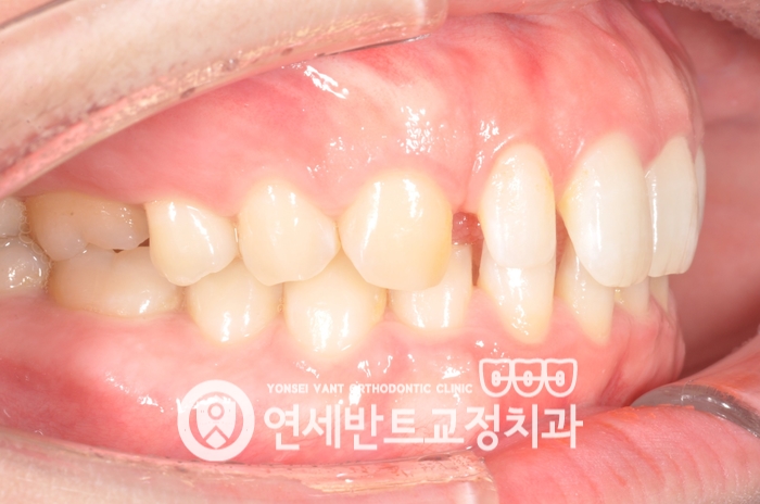 측면 교합 사진
