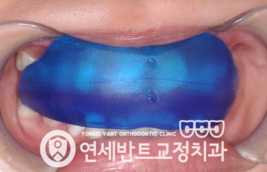 치아 본뜨기